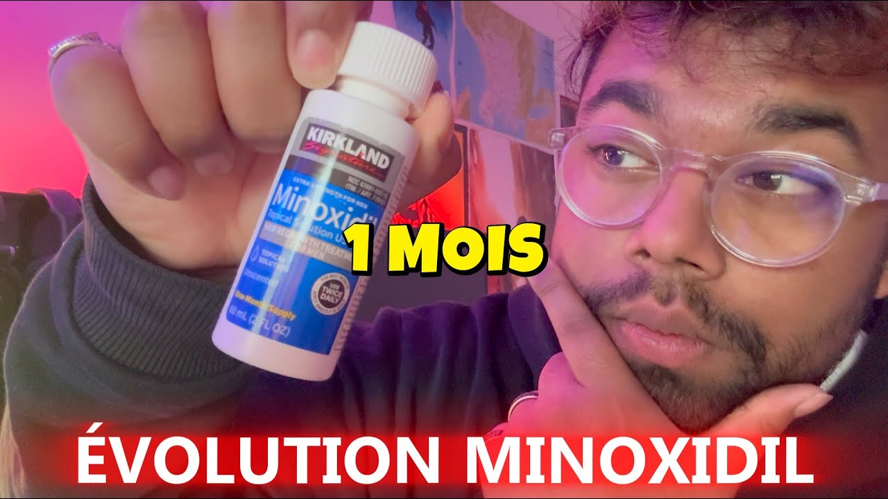 [MINOXIDIL BARBE] MON ÉVOLUTION 1 MOIS !