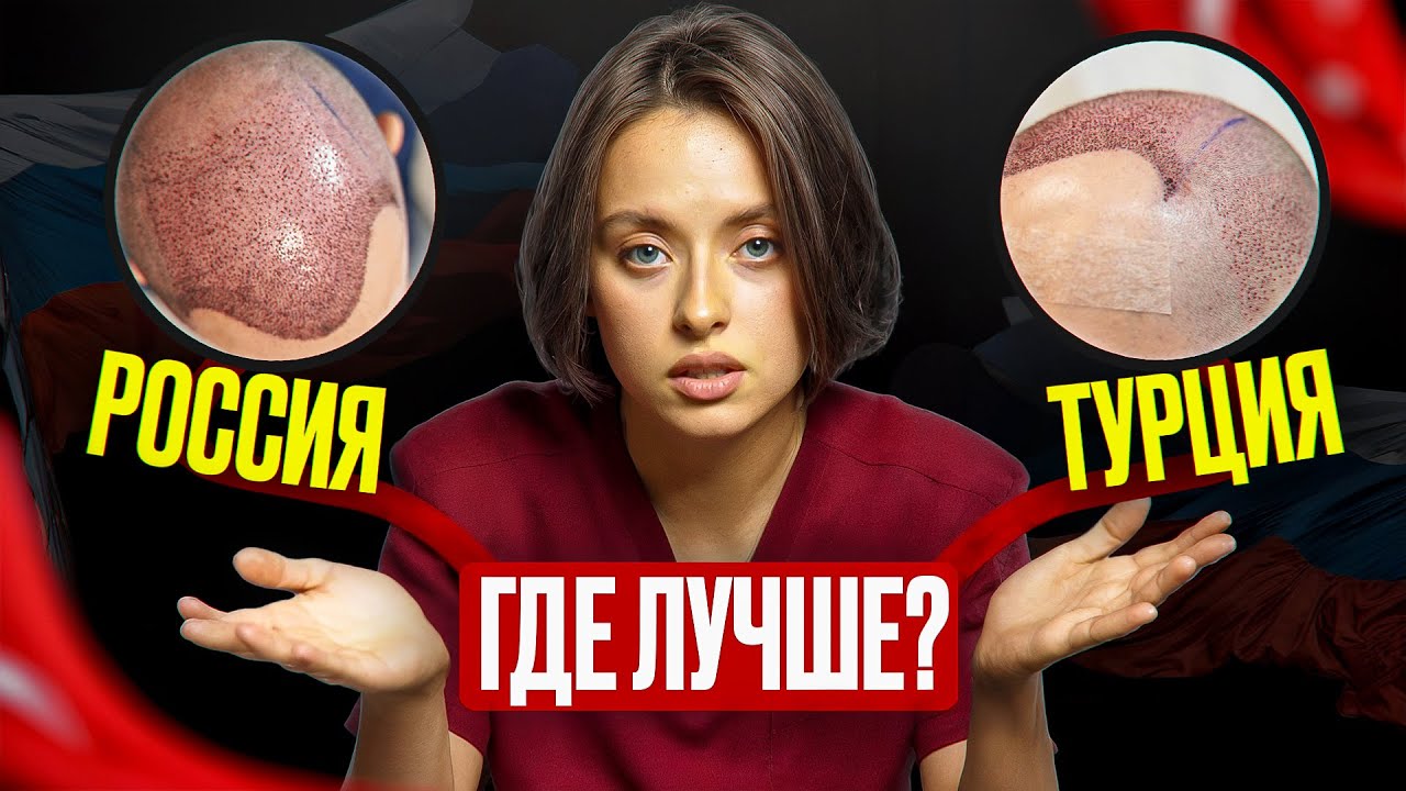 Пересадка волос в Турции и России