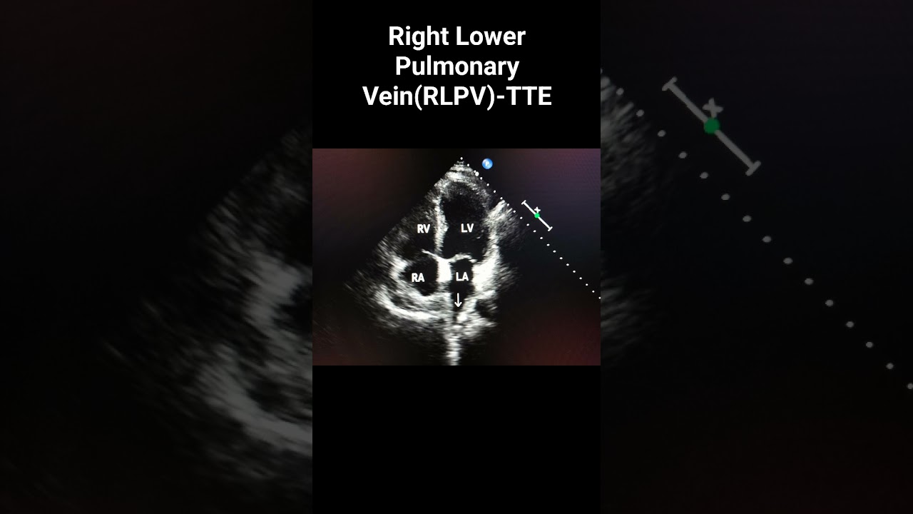 Right Lower Pulmonary Vein (RLPV)-TTE