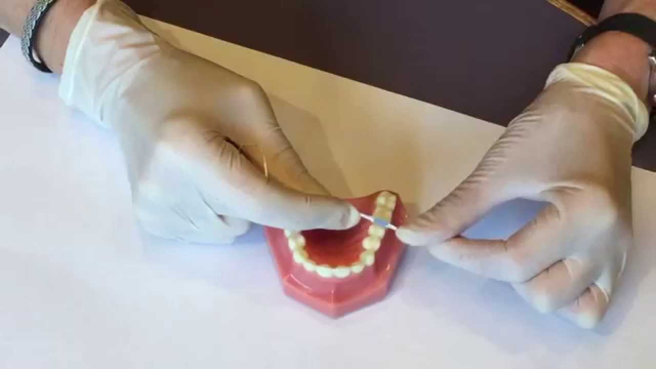How to replace your orthodontic separators (aka. spacers) at home.