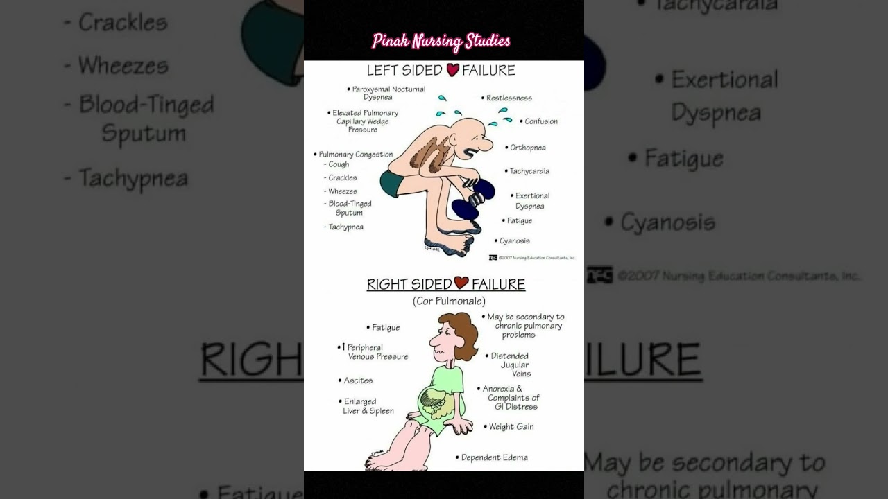 Left sided heart failure VS Right sided heart failure