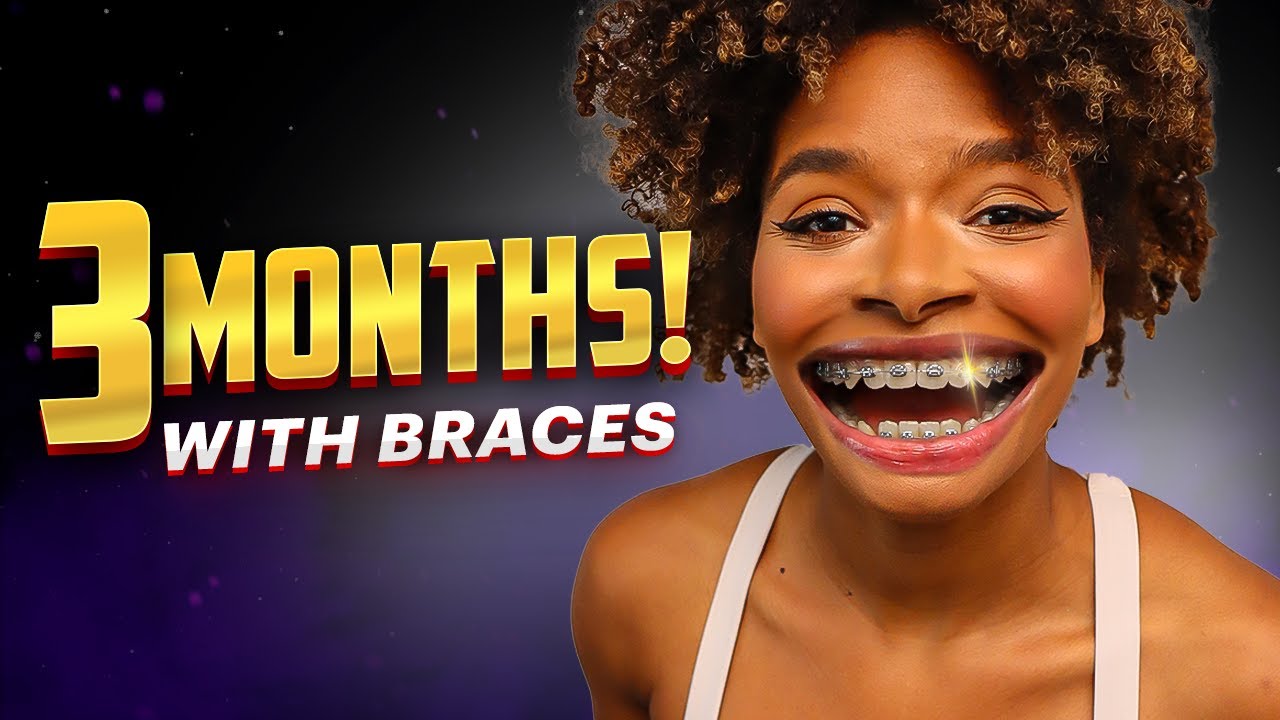 How My Smile Has Transformed in 3 Months with Adult Orthodontic Braces