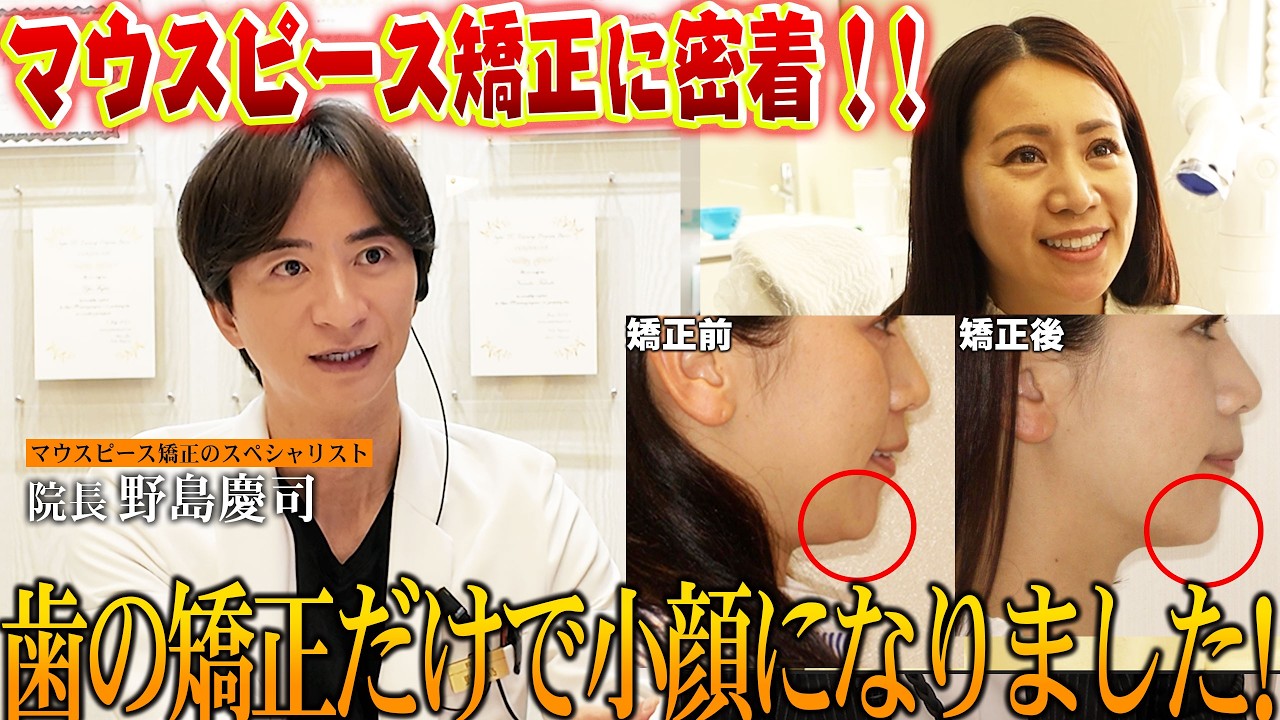 人前で思いっきり笑えるようになりました！30代女性の長年悩みをDr.野島が解決したら…小顔にも！その秘密に密着したドキュメンタリー！