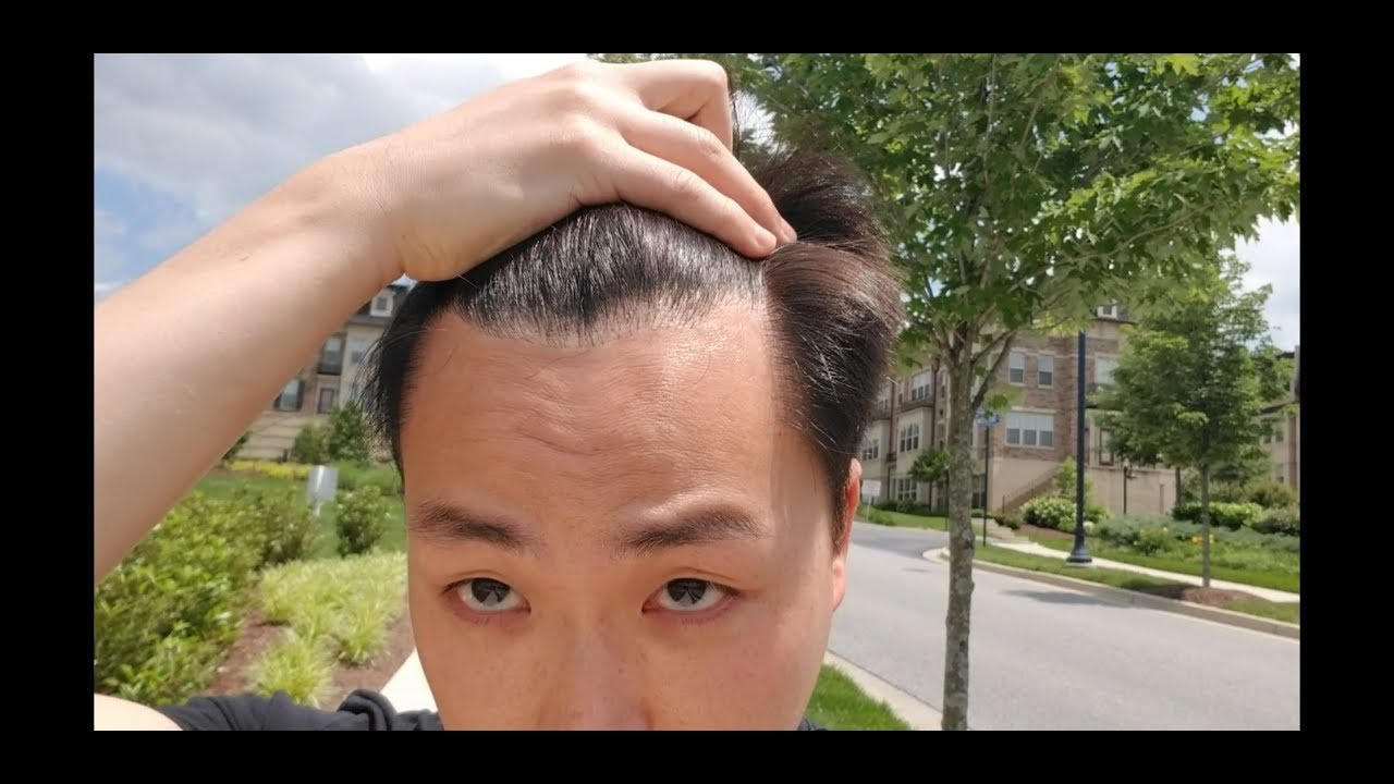 1.5 YEAR HAIR TRANSPLANT POST OP!