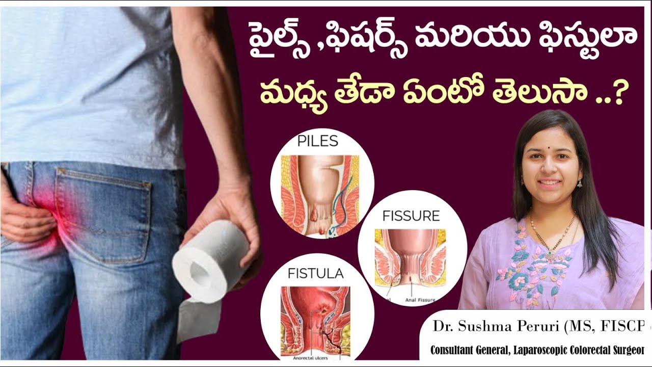 Difference Between Piles, Fissures and Fistula In Telugu || Health Facts || Supra Clinics