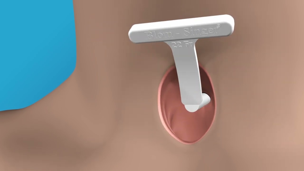 InHealth Technologies - Blom-Singer Dilator Sizer
