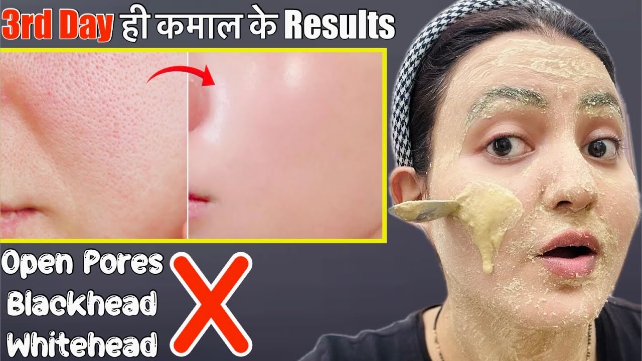 Glass Skin Transformation Series (Day 3) : Remove Open Pores Blackhead Whitehead in 5 Days💕