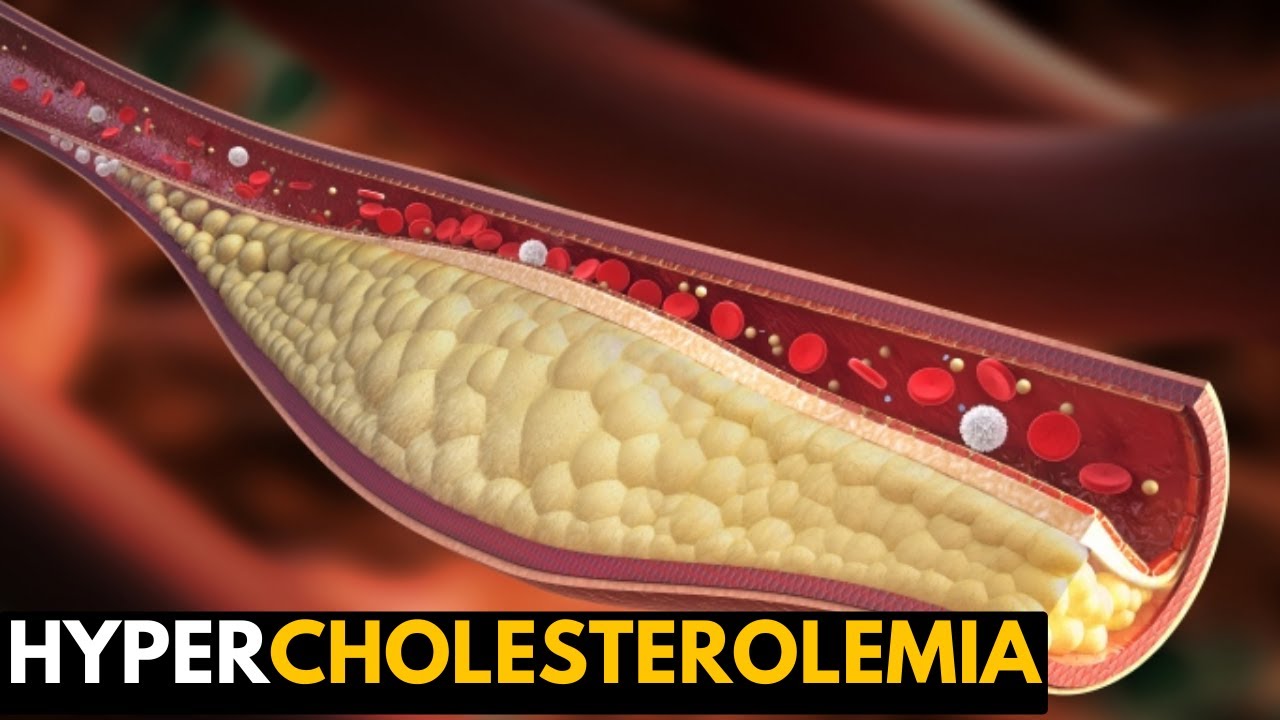 Hypercholesterolemia  Everything You Need to Know