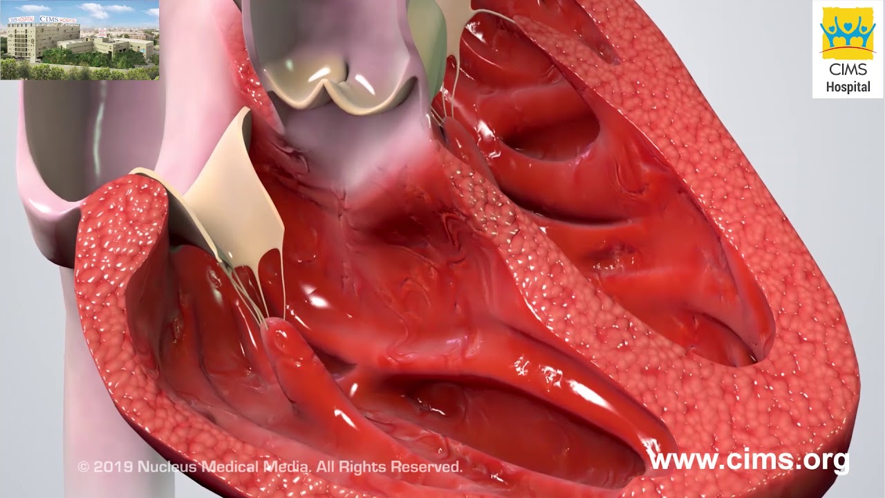 Understanding Tetralogy of Fallot &ndash; CIMS Hospital