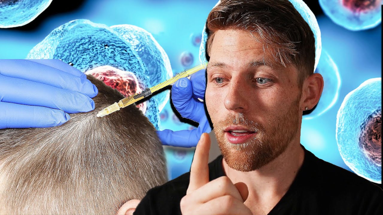 Stem Cell Therapy Gets MASSIVE Investment to CURE Hair Loss