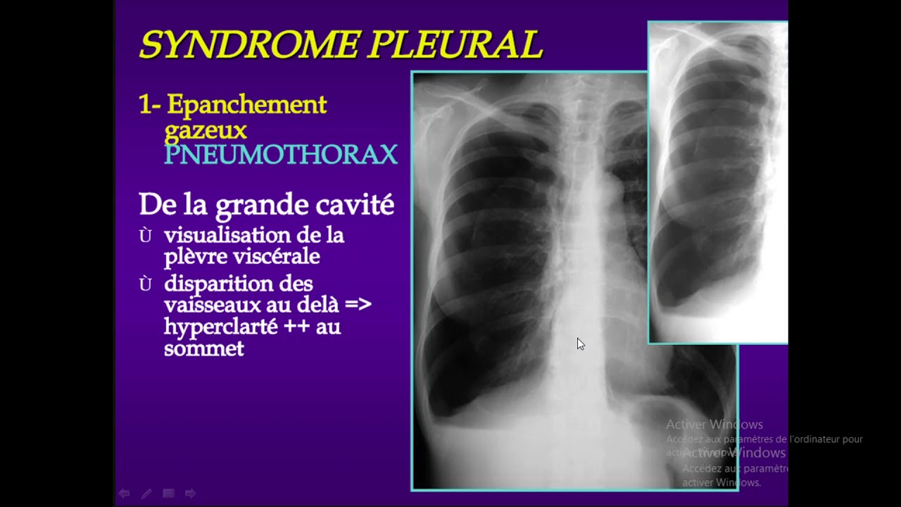 syndrome pleural