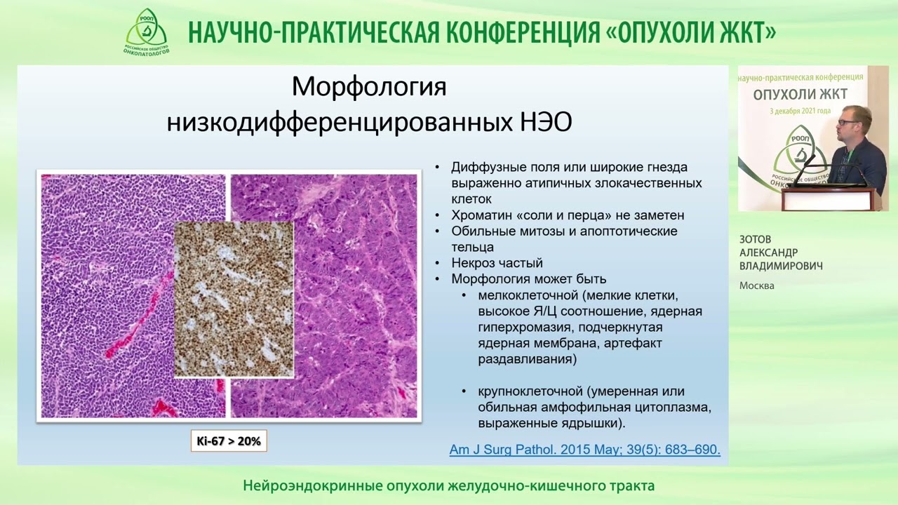 Нейроэндокринные опухоли желудочно кишечного тракта