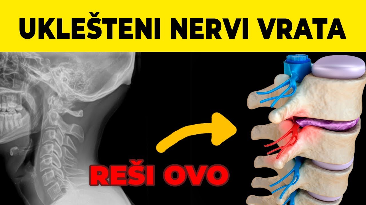 UKLEŠTENI NERVI VRATA? 📛 REŠI OVO ZA SAMO PAR DANA! ✅🧘‍♂️
