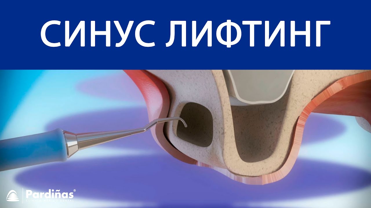 Синус лифтинг ©