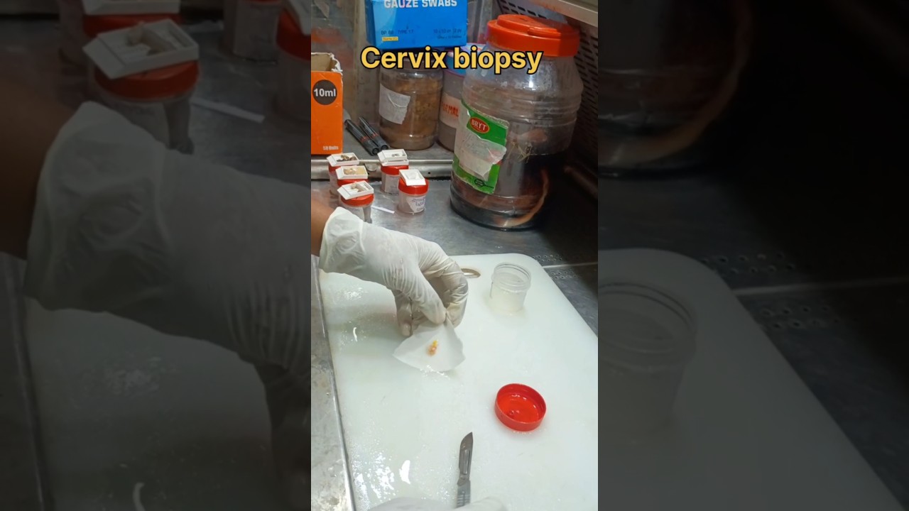 Cervical biopsy for screening cervical cancer | #histopathology #cervicalcancer #cervicaltreatment