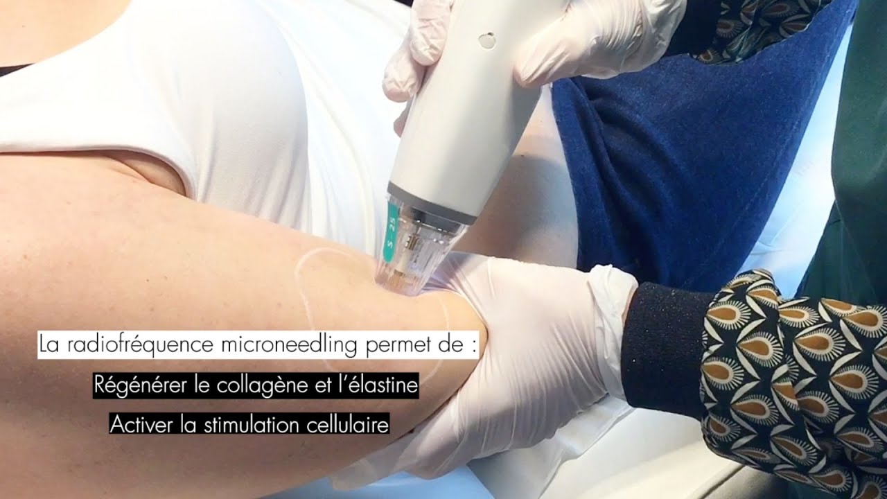 Éliminer les vergetures - Radiofréquence Microneedling POTENZA® - Clinique CLEM à Lille