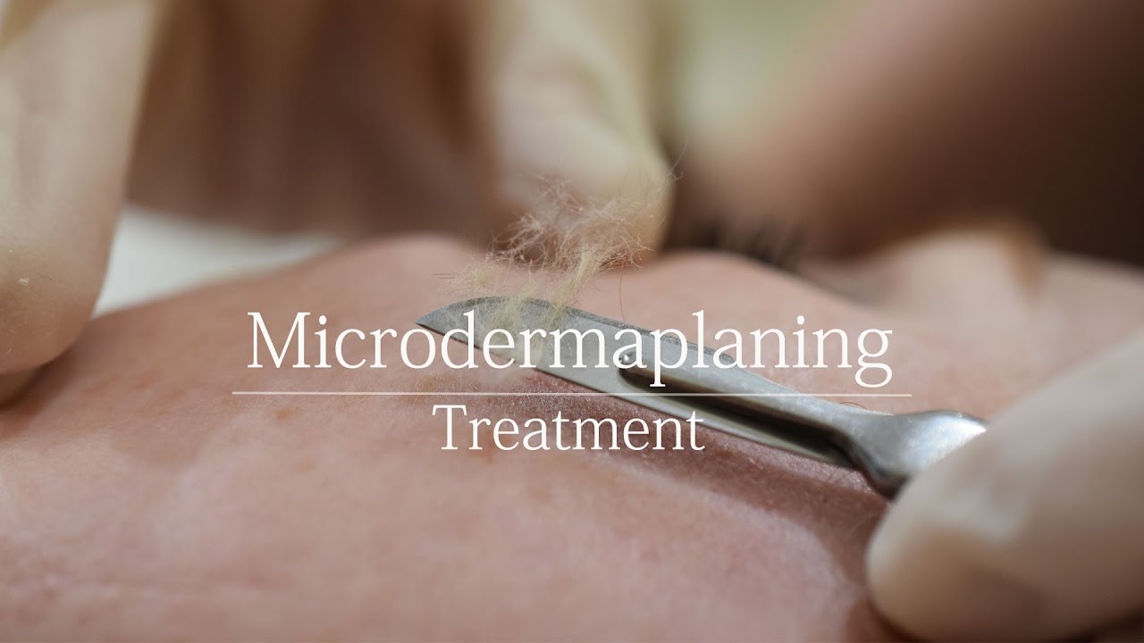 Microdermaplaning - treatment video