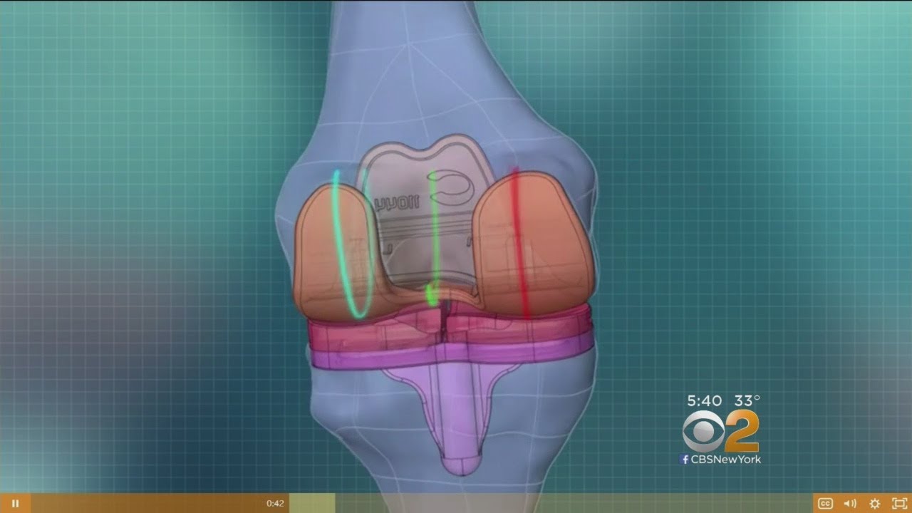 3D Printed Knees May Ease Replacement Surgery