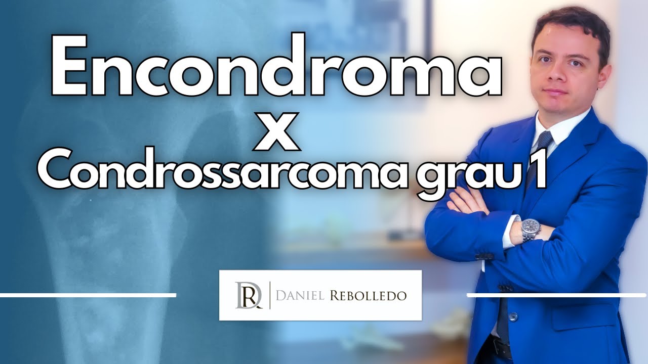 Encondroma x Condrossarcoma grau 1. O que você deve saber?
