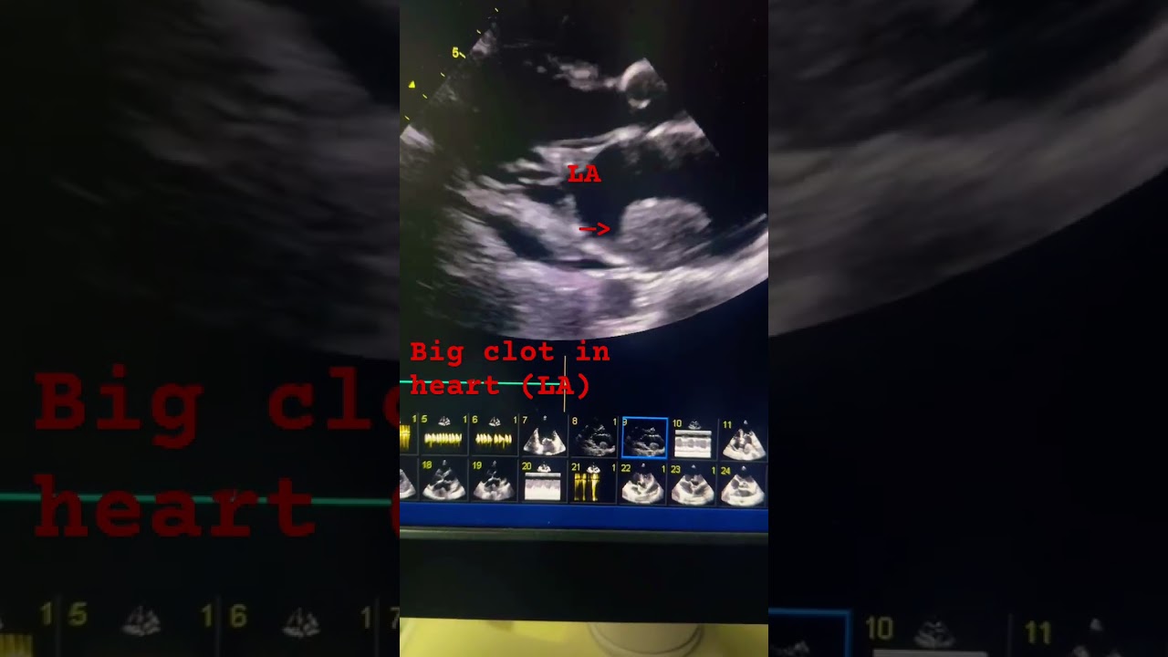 Big LA clot in RHD, atrial fibrillation #echocardiography #cardiology #mbbs #mbbsmotivation