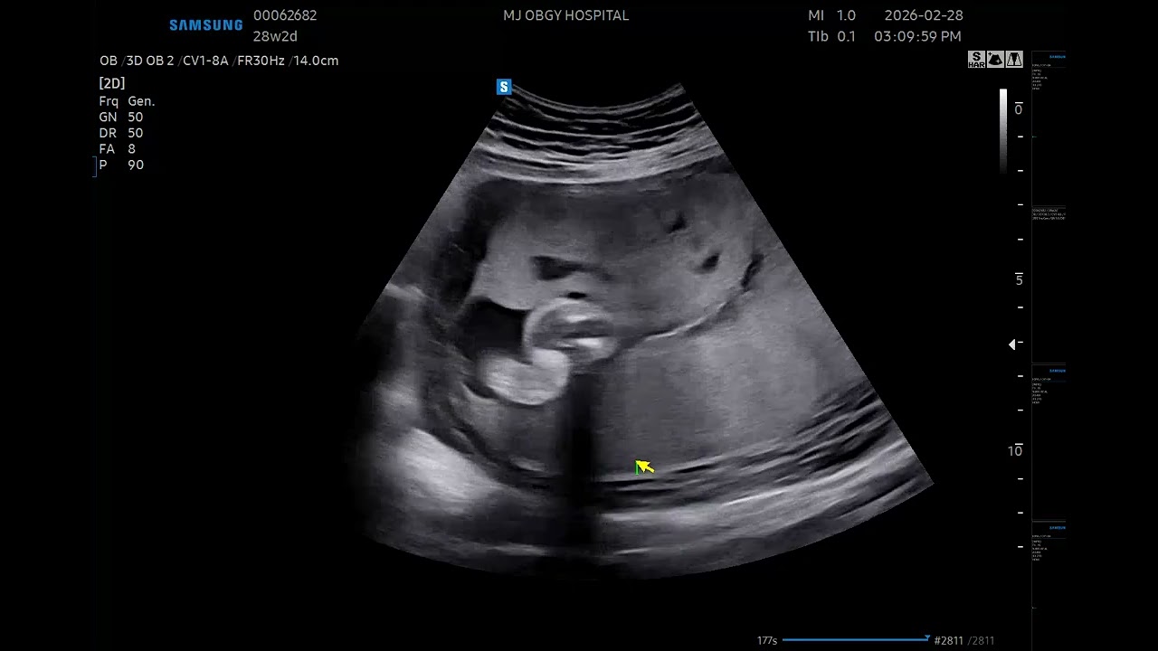 2026.02.28 땡글이 초음파 21