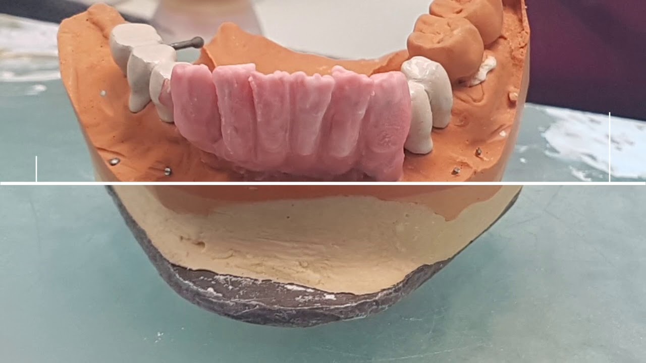 Circolare su impianti con gengiva in ceramica