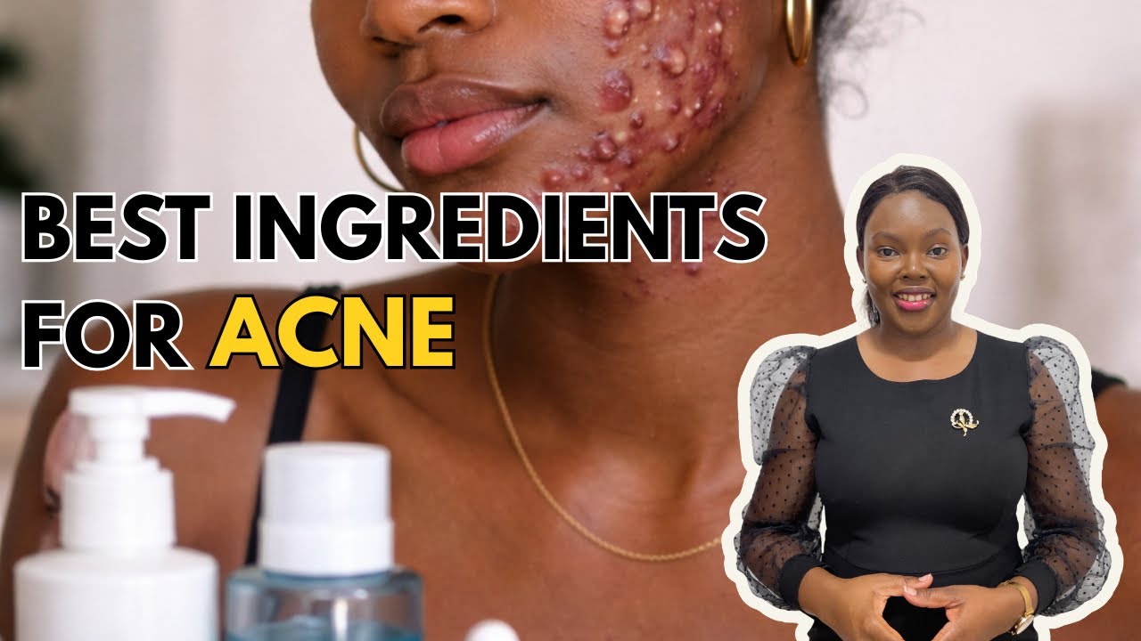 Acne Ingredients Explained | What Actually Works for Clear Skin | ACNE SERIES EPISODE 5