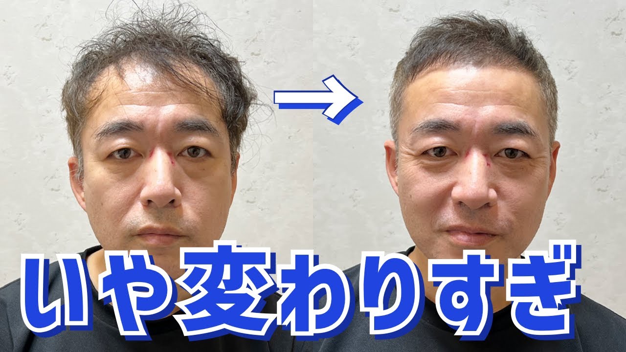 【薄毛】M字ハゲを目立たせないカット術