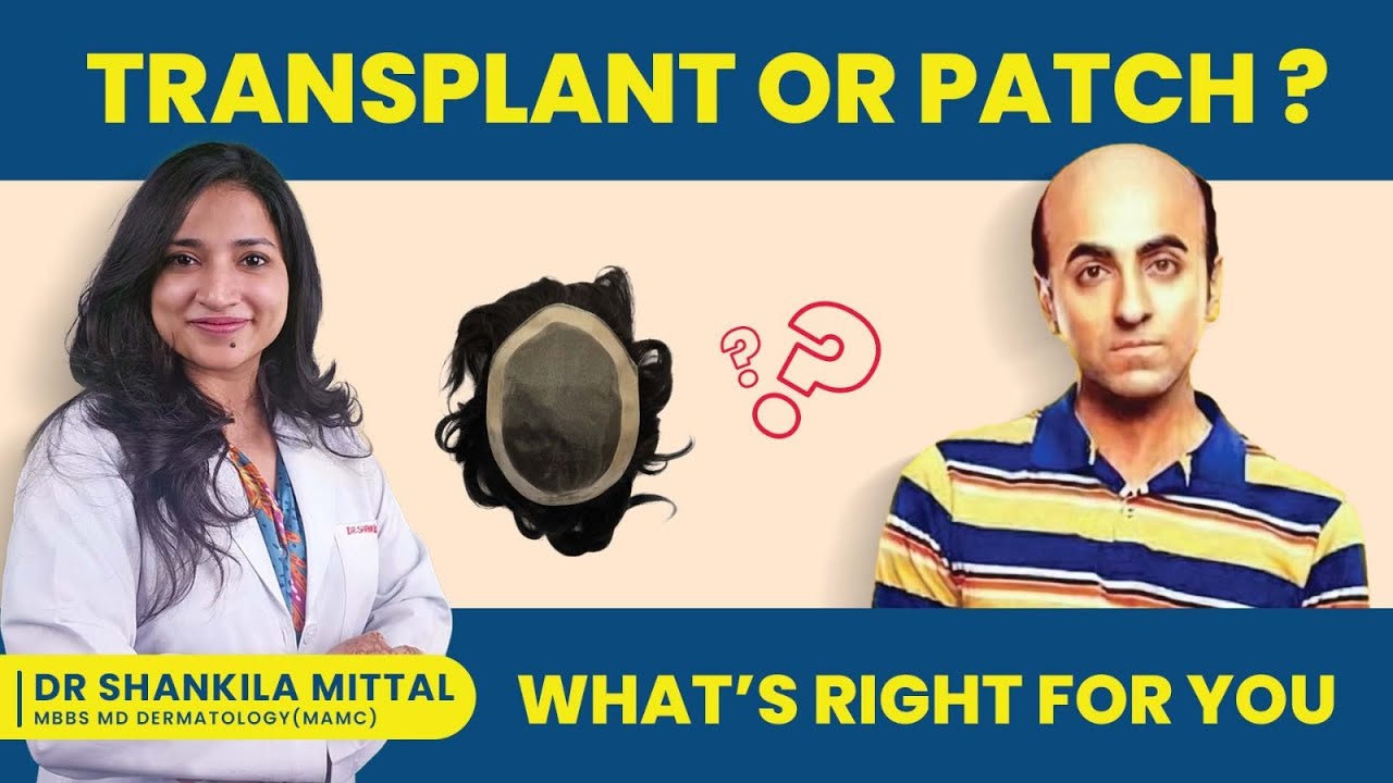 Hair Transplant or Hair Patch? 3 Things You MUST Check Before Deciding