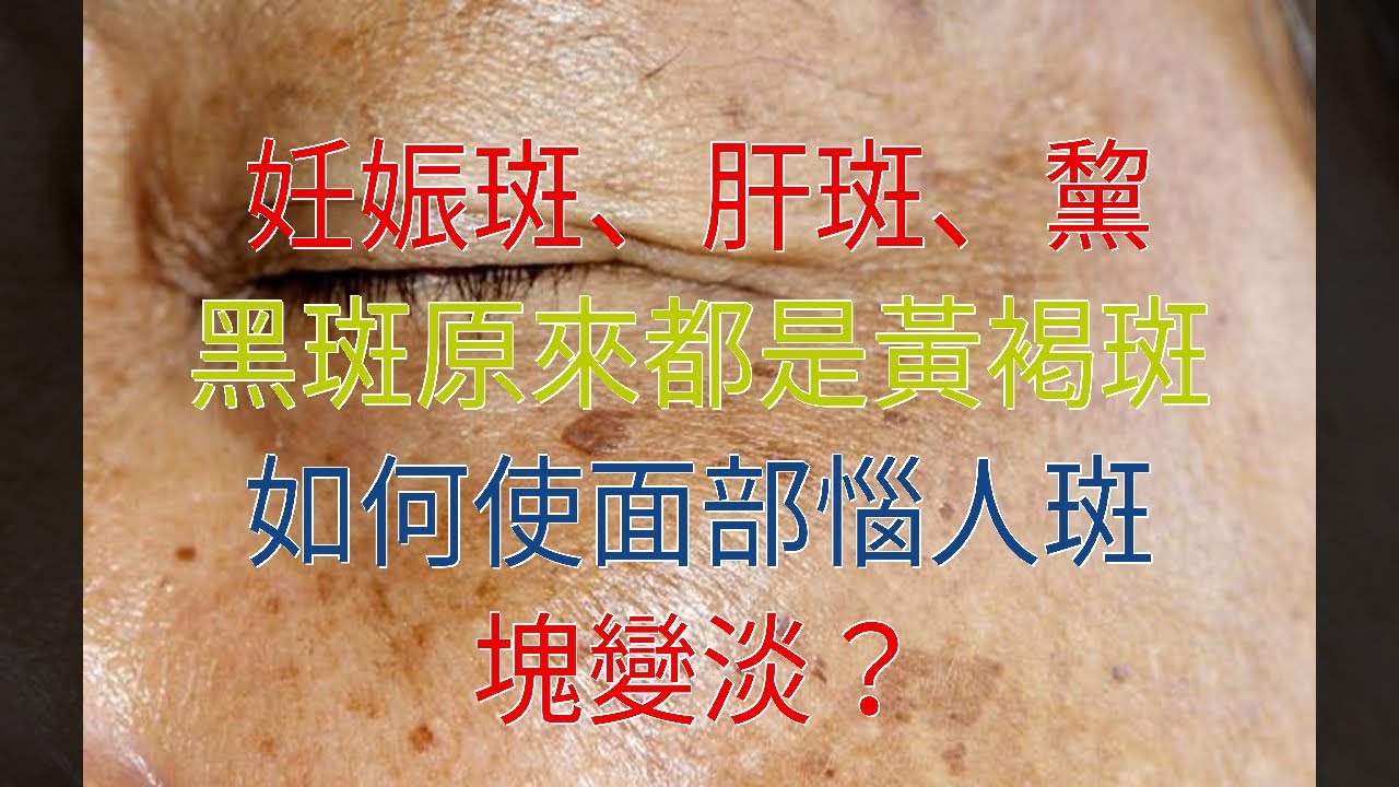 妊娠斑、肝斑、黧黑斑原來都是黃褐斑，如何使面部惱人斑塊變淡？