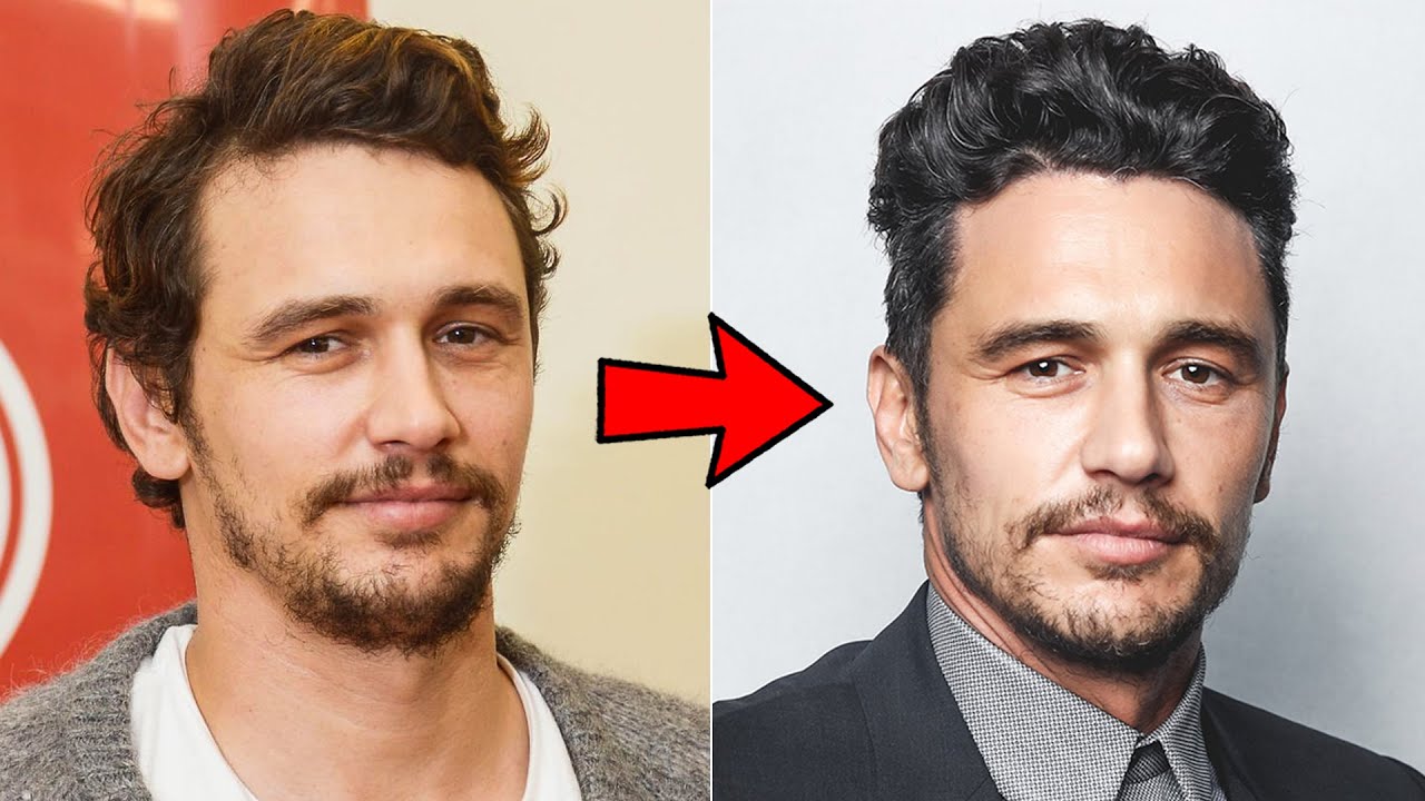 How James Franco Reversed His Hair Loss