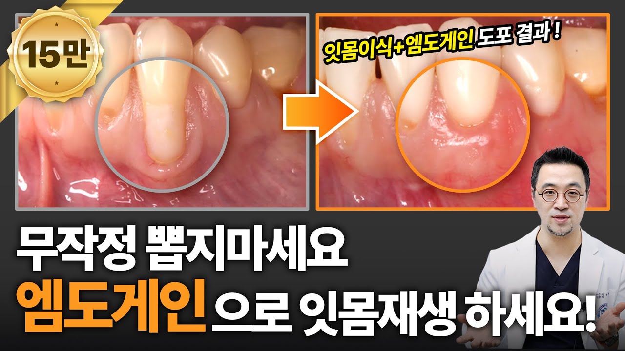 잇몸재생 시키는 엠도게인으로 자연치아 살리세요