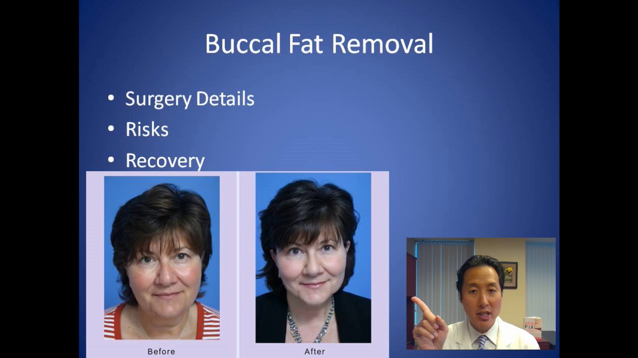 How Can I Reduce My Puffy Cheeks - Buccal Fat Removal Consultation - Dr. Anthony Youn