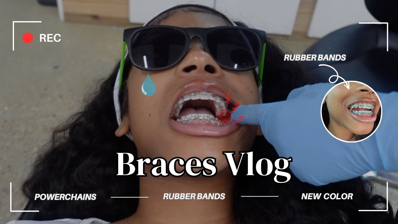 BRACES VLOG | NEW  COLOR + POWER CHAINS + I GOT RUBBER BANDS 😁✨