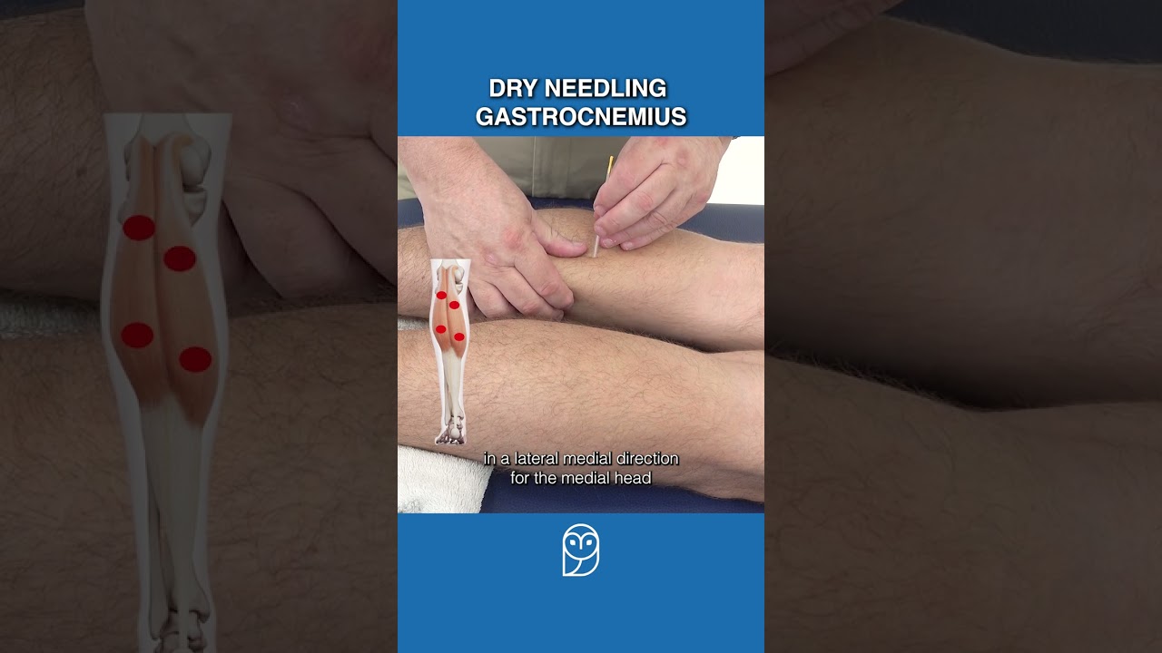 Как сушить иглу в икроножной мышце