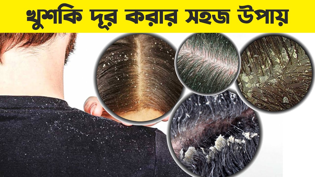 চুলের খুশকি দূর করার উপায় কী? শীতে খুশকি যেভাবে দূর করবেন || Remedy to Remove DANDRUFF