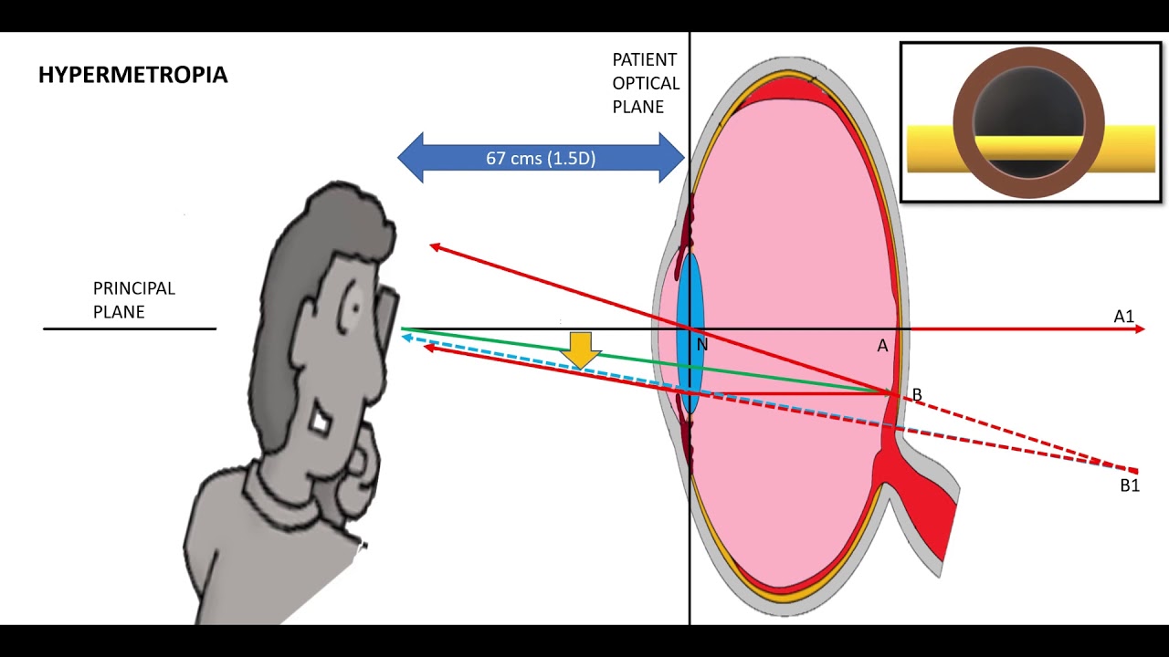 Retinoscopy part 1 Dr Zain Khatib