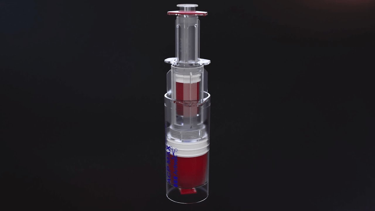 ACP Max™ Platelet-Rich Plasma System Technique Overview