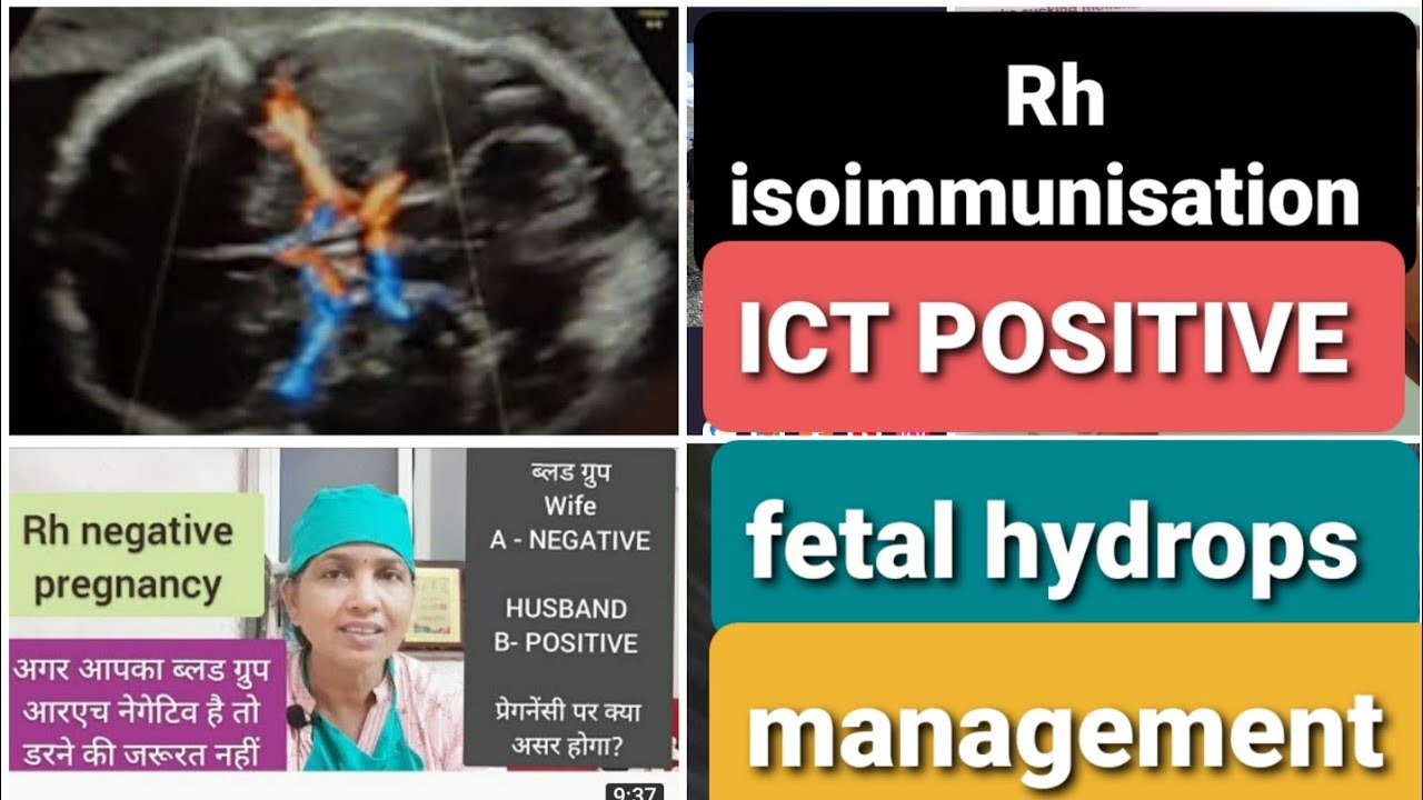 RH negative प्रेगनेंसी में ICT पॉजिटिव है ।अब क्या करें?  RH Isoimmunization & fetal hydrops