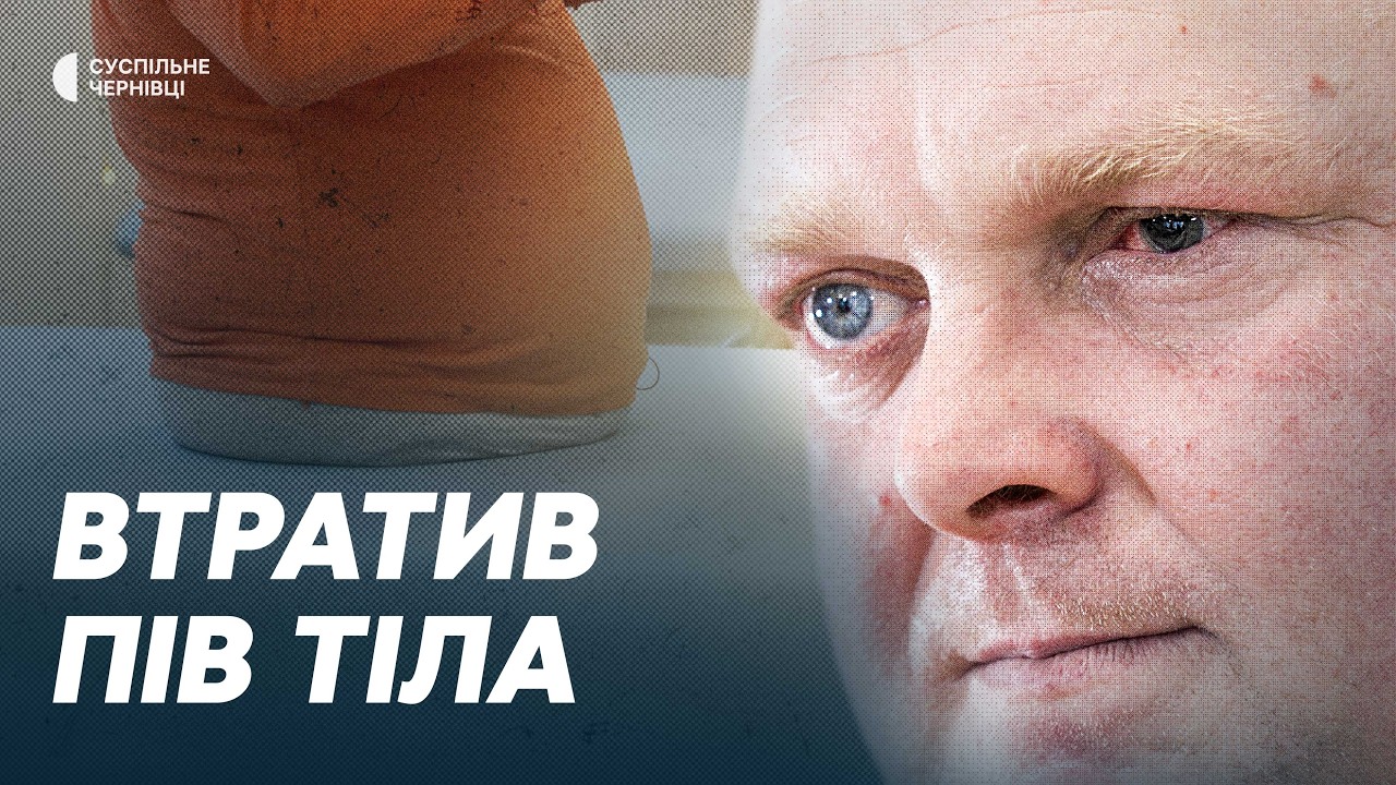 Частину ніг відсікло дроном, а потім високо ампутували — турнікетний синдром: що Сметаніну дає сил