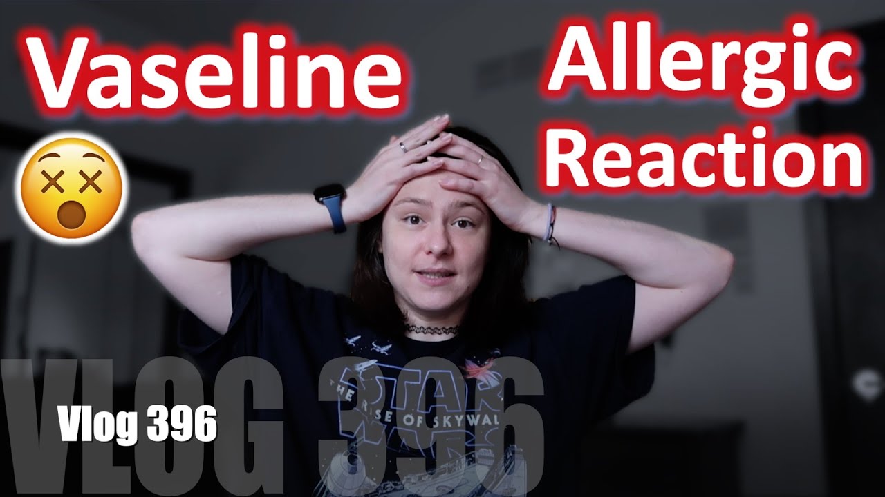 Ch.396: I Had An Allergic Reaction To Vaseline After My Scalp Biopsies
