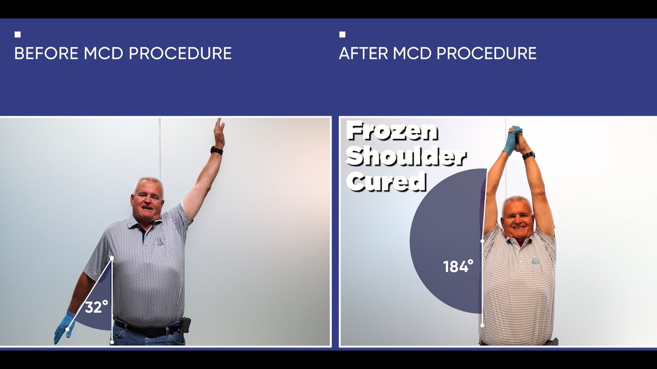 Repeat Success Story | Frozen Shoulder Gone in 2 Days, Twice