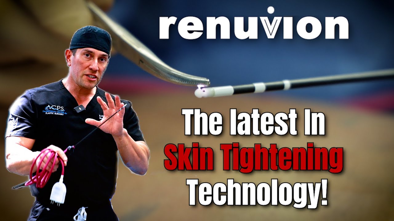 Tighter Skin with Renuvion: Dr. Morales Explains How and Why THIS WORKS!