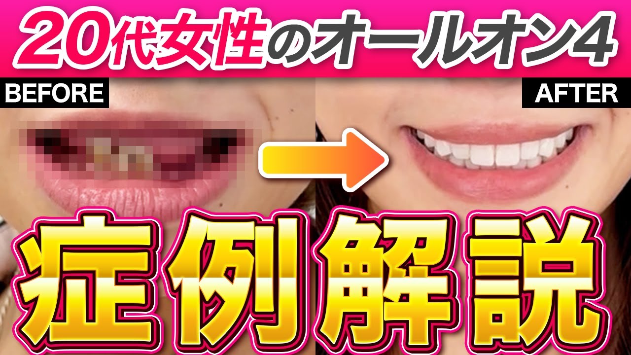 【症例解説シリーズ】歯がボロボロになってしまった｡｡｡20代女性のオールオン4