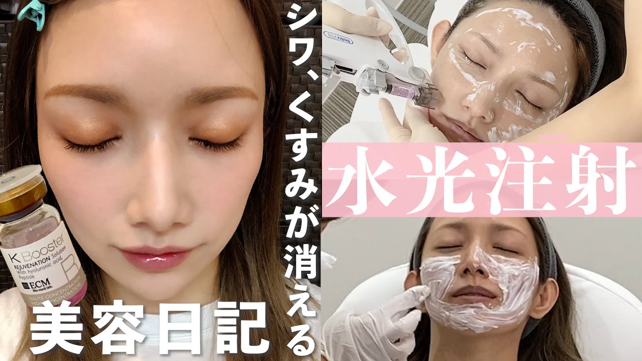 【水光注射】顔の内側から光だすと話題の美肌治療を徹底調査！！