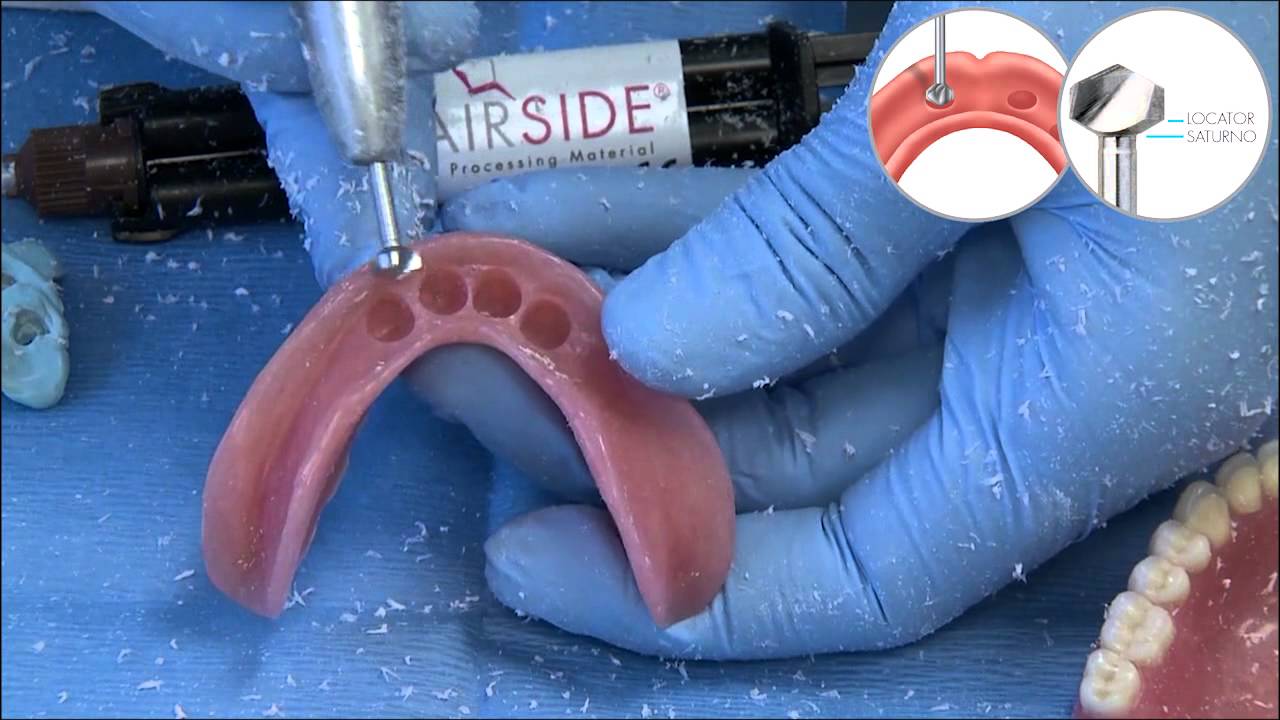 Clinical Demonstration: Zest CHAIRSIDE&reg; Denture Prep & Polish Kit