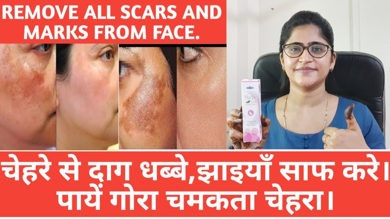 चेहरे से दाग धब्बे कैसे हटाये।।Acne pimples chickenpox marks।।how to remove acne pimples।।