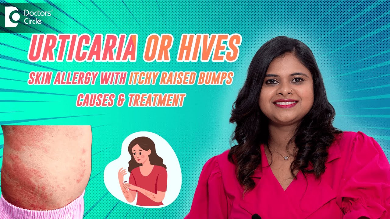 Hives on skin | Skin Allergy |Best Treatment for skin #allergy | #urticaria treatment-Dr.Radhika S R