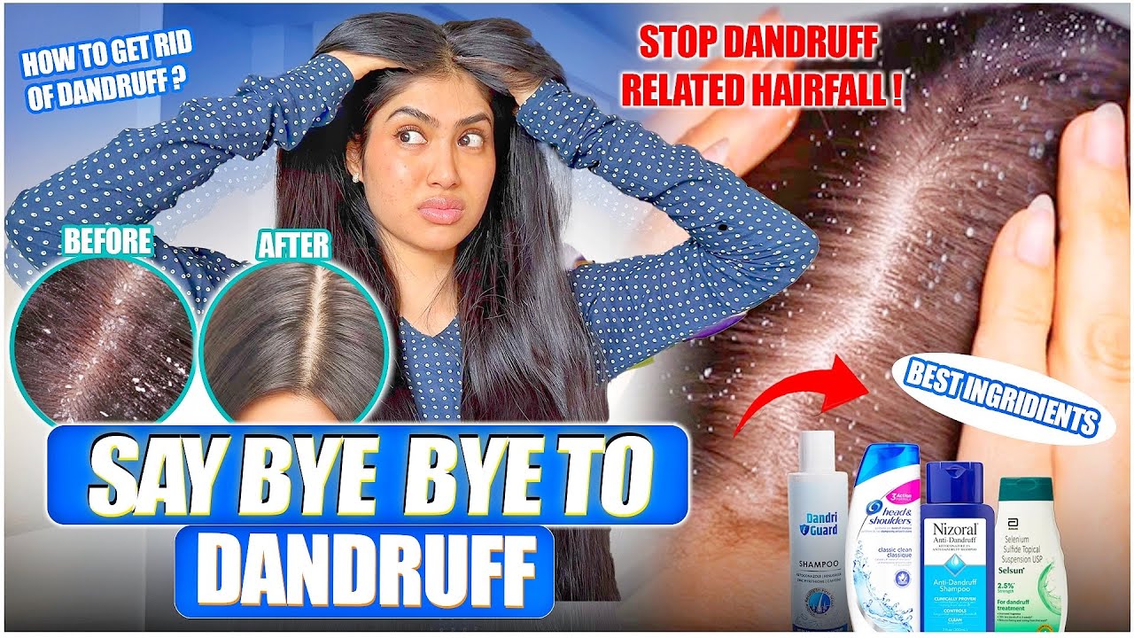 Best anti-dandruff shampoo with visible results in first use| how to get rid of dandruff completely 