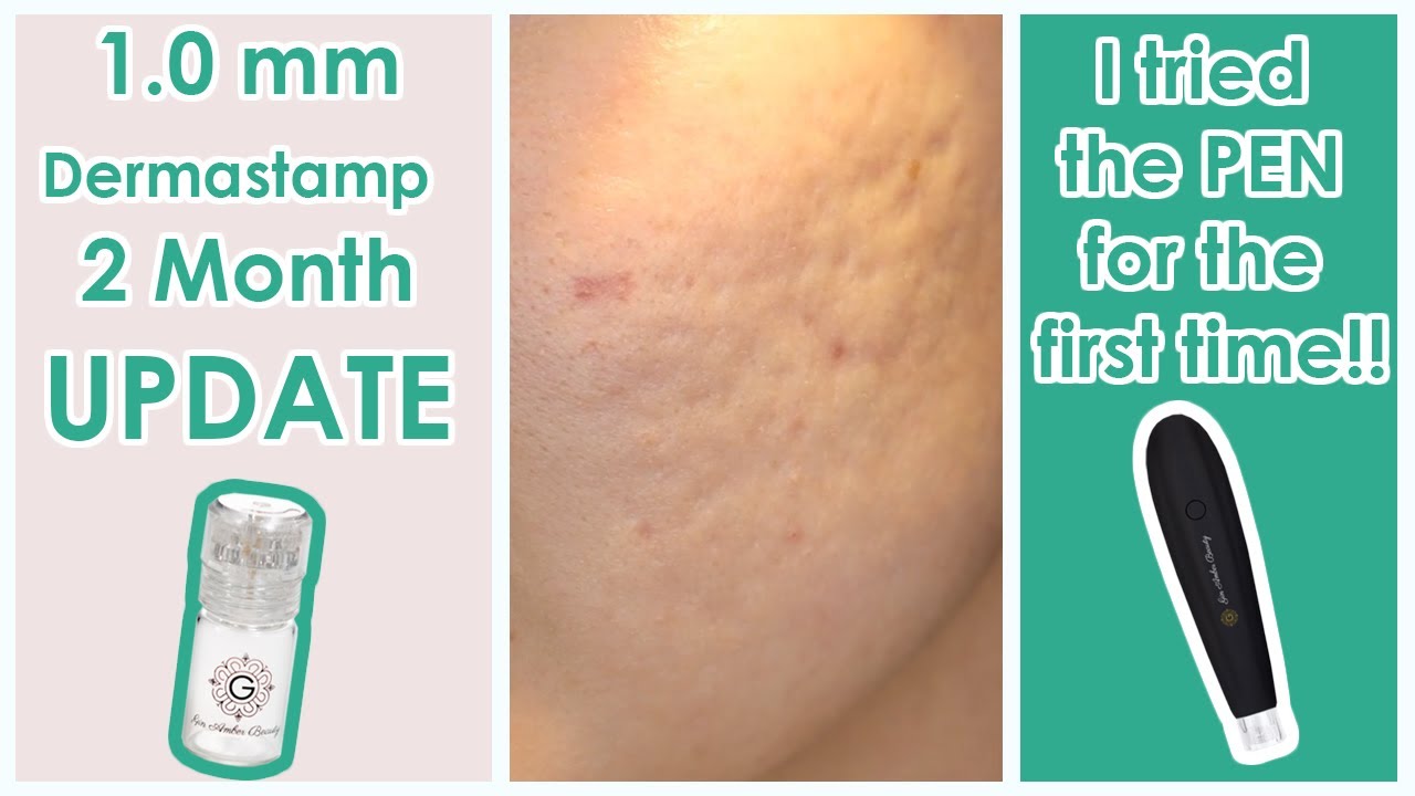 1.0mm Microneedling 2 Month Update!